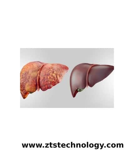 تشخیص کبد چرب از روی رگ دست